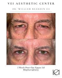 ✨ Lifted + refreshed ✨ Upper lid bleph, ptosis repair, and internal brow  elevation took away the heaviness and opened her eyes beautifully.  #BeardenBlephs #ASOPRS #OculoplasticSurgery #LaserBlepharoplasty  #RichmondVA #Blepharoplasty #PtosisRepair ...