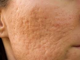 Primele simptome ale varicelei sunt: Varicela La BebeluÈi Qbebe Ro