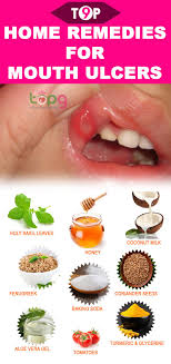 My 1 Tip For Canker Sores Or Mouth Sores Is To Use L Lysine Can Be Found At Most Natural Food Stores Vitamin Sh Mouth Ulcers Canker Sore Ulcer Remedies Mouth
