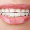 On average, it takes about one to three years for braces to work and straighten teeth. Https Encrypted Tbn0 Gstatic Com Images Q Tbn And9gcseg9bhzx0d9d0fhq Wk71 B07pgi3zivvcqbe0rmvb3eg8heew Usqp Cau
