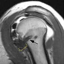 Image result for Shoulder Imaging