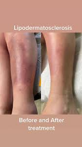 Image result for Lipodermatosclerosis