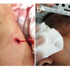 The gunshot wound to the back of the president's head was described by the bethesda autopsy as a laceration measuring 15 by 6 millimetres (0.59 in × 0.24 in), situated to the right and slightly above the external occipital protuberance. Pdf Atypical Gunshot Injury To The Neck With An Unexpected Nonlinear Bullet Trajectory A Case Report And Review Of The Literature