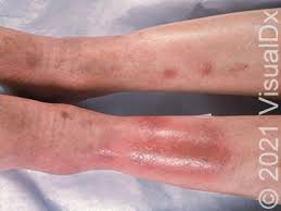 Image result for Panniculitis