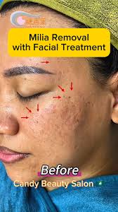 Candy Beauty Salon has various facial treatment to fix your skin problems.  Let's contact us for information., #Facial #FacialTreatment #Milia  #BeforeAndAfter #CandyBeautySalon #MissCandyMacau #Macau