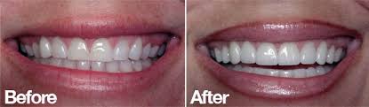 To insert your veneers, slip the snap on teeth over your own front teeth and apply gentle pressure to. Before And Afters For Porcelain Veneers San Diego