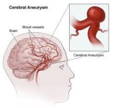 In cases of small and unchanging brain aneurysms, there can be no symptoms. Brain Aneurysms Johns Hopkins Cerebrovascular Center