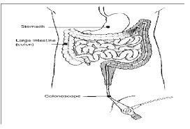 Make sure that you drink plenty of water throughout rest of the day, even if it hurts to swallow. Combined Upper Gi Endoscopy And Colonoscopy Hull University Teaching Hospitals Nhs Trust