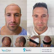 Vera Clinic Hair Transplant In Turkey Hair Transplant Results Hair Transplant Best Hair Transplant