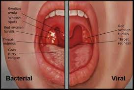 There are far fewer tonsillectomies as a result during examination of oropharynx,no visible tonsil may be found in between the anterior and posterior pillar,whereas the other tonsil might. Pin By Laura Benavidez On Share Treatment For Sore Throat Nursing Tips Health