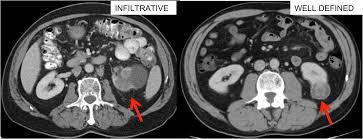 A ct scan works quite like a normal x ray and produces numerous images or pictures of the inside of. Kidney Cancer Diagnosis Johns Hopkins Medicine