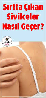 Sirtta Cikan Sivilceler Nasil Gecer Cilt Bakimi Saglik Cilt Bakimi Tuyolari