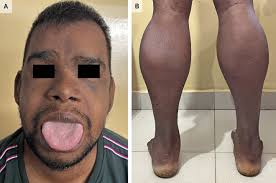 Image result for Myopathy