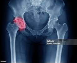 Image result for Hip XRay