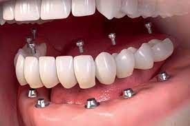 4 Effective Remedies That Remove Wrinkles And All Aging Signs Dental Implants Implants Gum Treatment