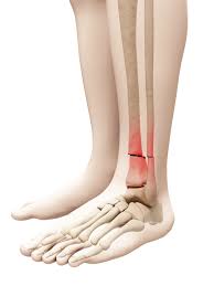 Elle avait du mal à marcher avec ses talons aiguilles. Fracture Du Tibia Duree Que Faire