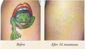I mean, if i had a nickel for every time i've heard, doesn't that. Affordable Tattoo Removal Using Infrared Light