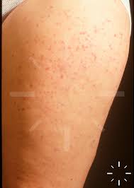 Image result for Urticaria pigmentosa children