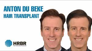 Anton du beke was born on july 20, 1966 in kent, england as anthony paul beke. Strictly Come Dancing S Anton Du Beke Hair Transplant Surgery Video Testimonial Hrbr Youtube