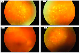 Image result for HIV Retinitis