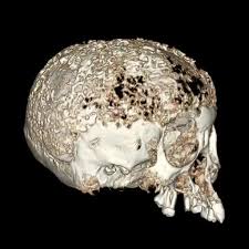 Image result for Tertiary Syphilis