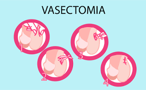 Complicanze della vasectomia la vasectomia è una procedura sicura a bassissimo livello di analizziamo alcuni pro e contro dell'intervento di vasectomia. Todo Lo Que Debe Saber De La Vasectomia Sin Bisturi Como Metodo Anticonceptivo Dr Felipe Velez