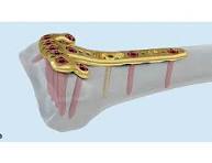 2.4 mm VA-LCP Volar Rim Distal Radius Plate