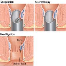 Image result for hemoroid human