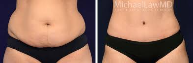 Belly Button Before After Photos