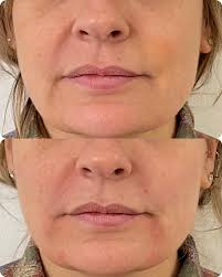 So… for my gorgeous client it was about creating volume and crisp borders.  Beautiful results 👄😊 #vermillionborder #cupidsbowlift #lipstolove  #lipfillerwigan #fillerswigan #aestheticsclinic #bellaaestheticswigan