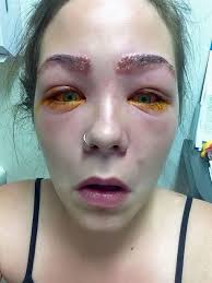 We offer a special lash & brow tint combo! Eyebrow Tinting Gone Wrong Teen Experiences Severe Reaction To Home Dye Kit