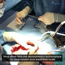 Op?ration du canal carpien video. Dr Brutus Montreal Facebook