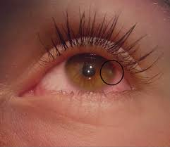 Grauer Kleiner Punkt Auf Der Iris Auge Trant Schmerzt Und Ist Rot Gesundheit Krankheit Schmerzen