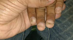 Koilonychia is usually caused through iron deficiency anemia. Iron Deficiency Anemia With Koilonychia Spoon Nails Youtube