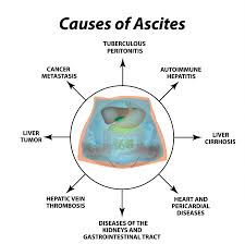 Image result for Ascites