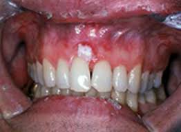 Image result for gums cancer symptoms