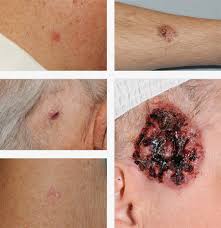 What does skin cancer look like? Symptoms Diagnosis Creating Beauty