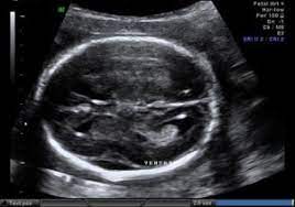 19 20 Week Scan So Gi Scan
