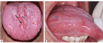 Image result for Fissured tongue