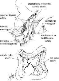 Colectomy with colocolonic, ileocolonic, or jejunocolonic anastomosis may be performed depending on the extent of the disease. References In Esophageal Replacement For Benign Disease Techniques In Gastrointestinal Endoscopy