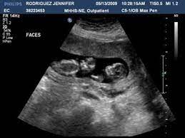 14 Weeks Faces I Had My 14 Week Ultrasound Today And Found Out That I Am Having Identical Twin Twins Ultrasound Ultrasound Pictures Baby Ultrasound Pictures
