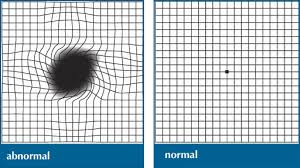 macular degeneration diagnosis efei