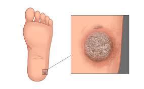 Plantar warts on foot, also known as verrucas, are caused by low risk hpv virus type 1/2/4. Warts Health