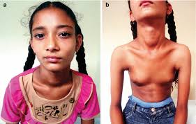 Image result for Precocious Puberty