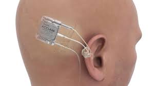 Image result for Cochlear Implant