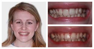 Six Month Smiles Testimonials