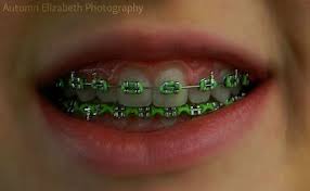 Black And White Braces For Teeth Brace Race Dental Braces Colors Braces Teeth Colors Braces Colors