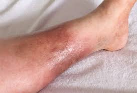 Image result for liver spots on legs