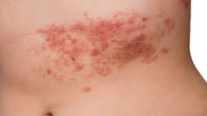 Rash 22 Common Skin Rashes Pictures Causes And Treatment