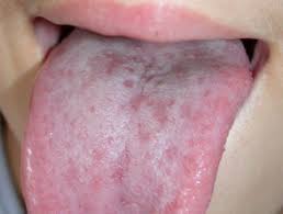 Hand foot and mouth pictures. Hand Foot And Mouth Disease Images Dermnet Nz